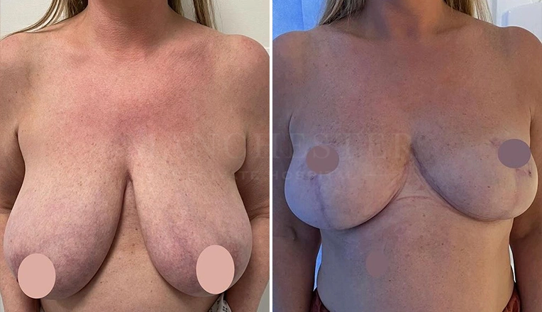 breast-reduction-before-and-after