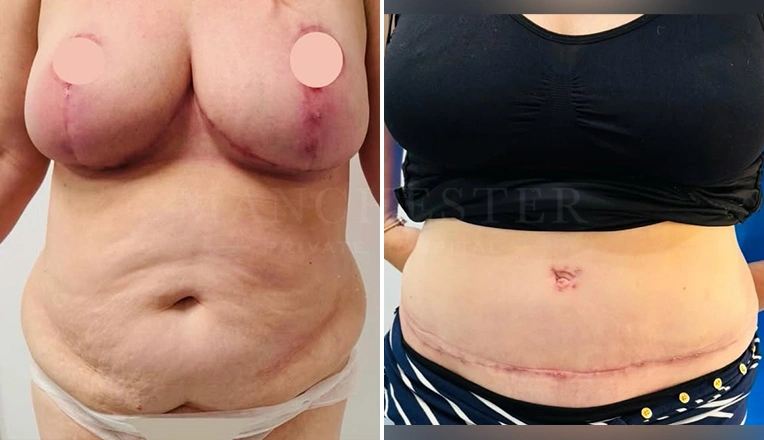 breast reduction, full tummy tuck and vaser liposuction
