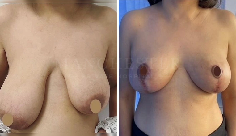 breast reduction results and symmetry