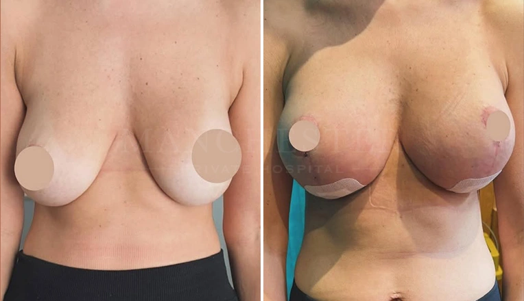 breast uplift and enhancement before and after