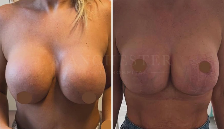 breast uplift before and after