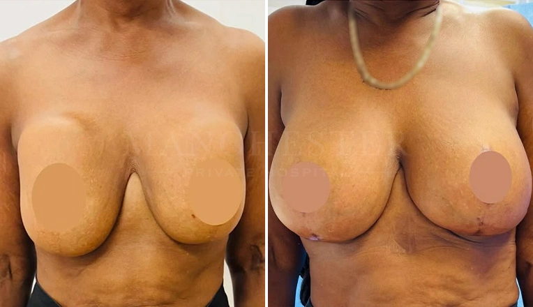 breast uplift before and after