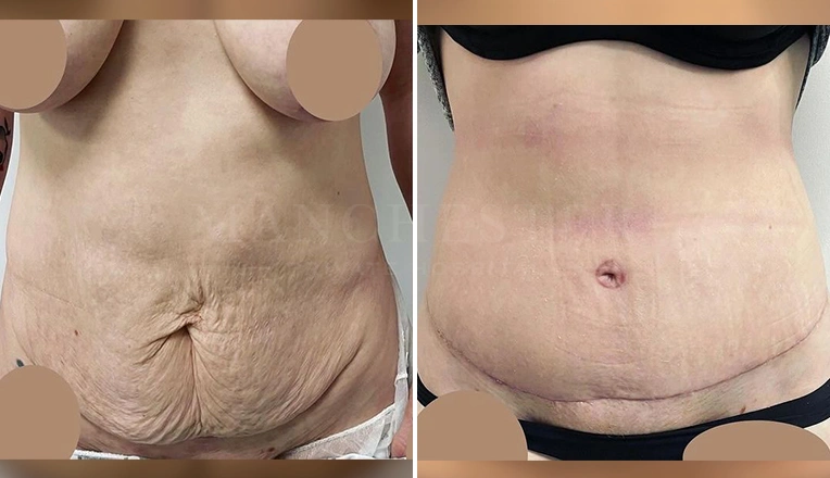 full abdominoplasty before and after result