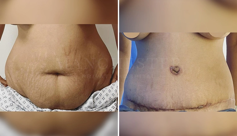 full tummy tuck and liposuction before and after result