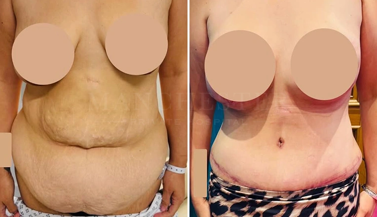 full tummy tuck and liposuction