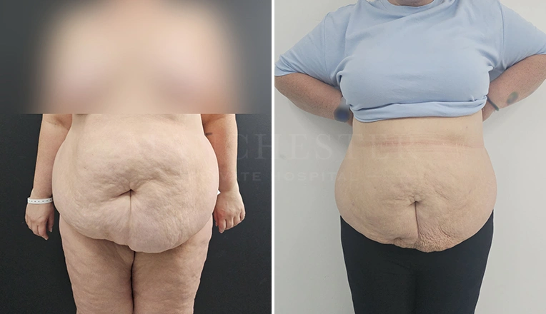 stomach vaser lipo before and after result-18