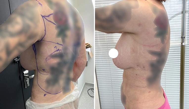 stomach vaser lipo before and after result-19