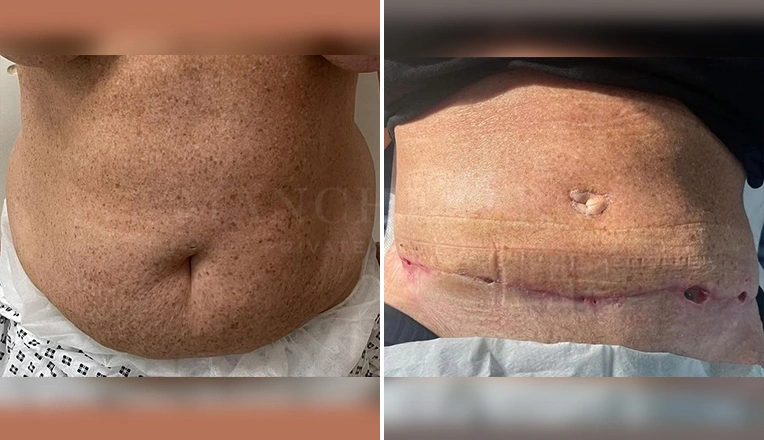 tummy tuck and liposuction before and after result