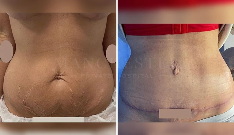tummy tuck before and after