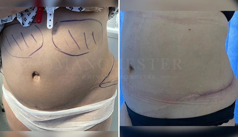 tummy tuck tweak with vaser liposuction and removal of dog ears-1