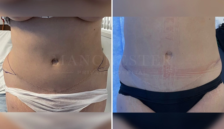 tummy tuck tweak with vaser liposuction and removal of dog ears