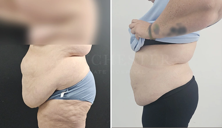 vaser lipo before and after stomach result-18-v1