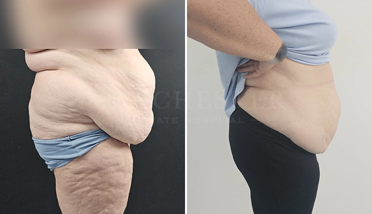vaser lipo before and after stomach result-18