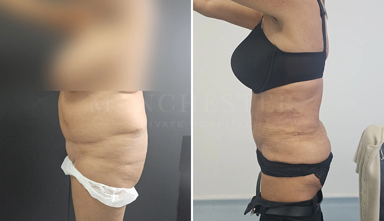 vaser lipo before and after stomach result-19-v1