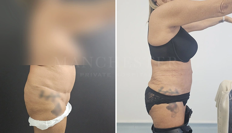 vaser lipo before and after stomach result-19