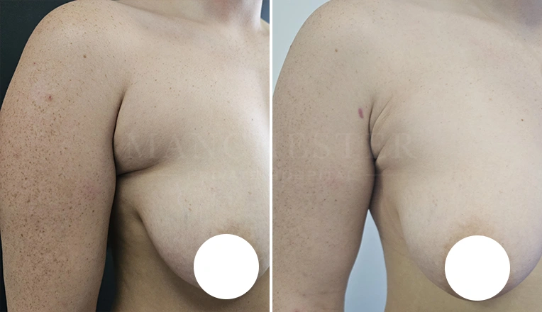 vaser liposuction on flanks and bra rolls-2