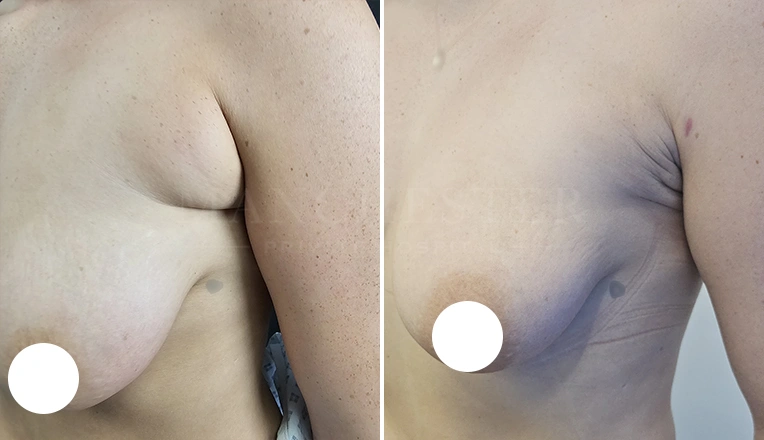 vaser liposuction on flanks and bra rolls