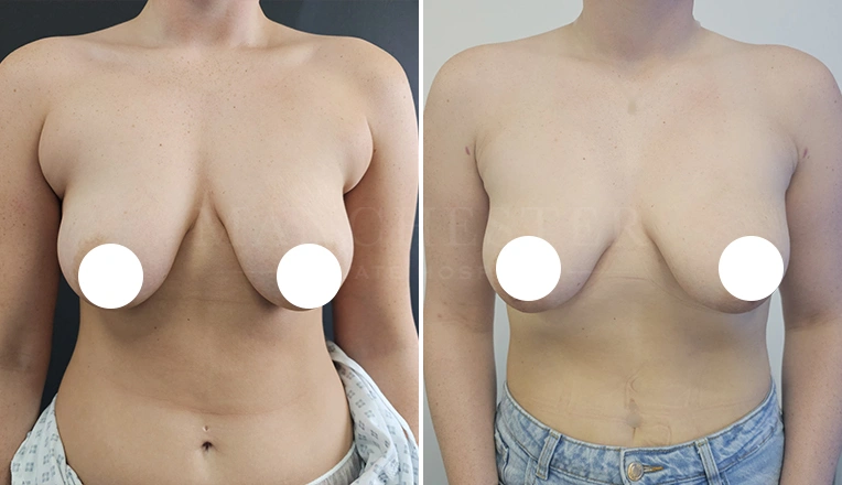 vaser liposuction on upper and lower abdomen and flanks and bra rolls aft