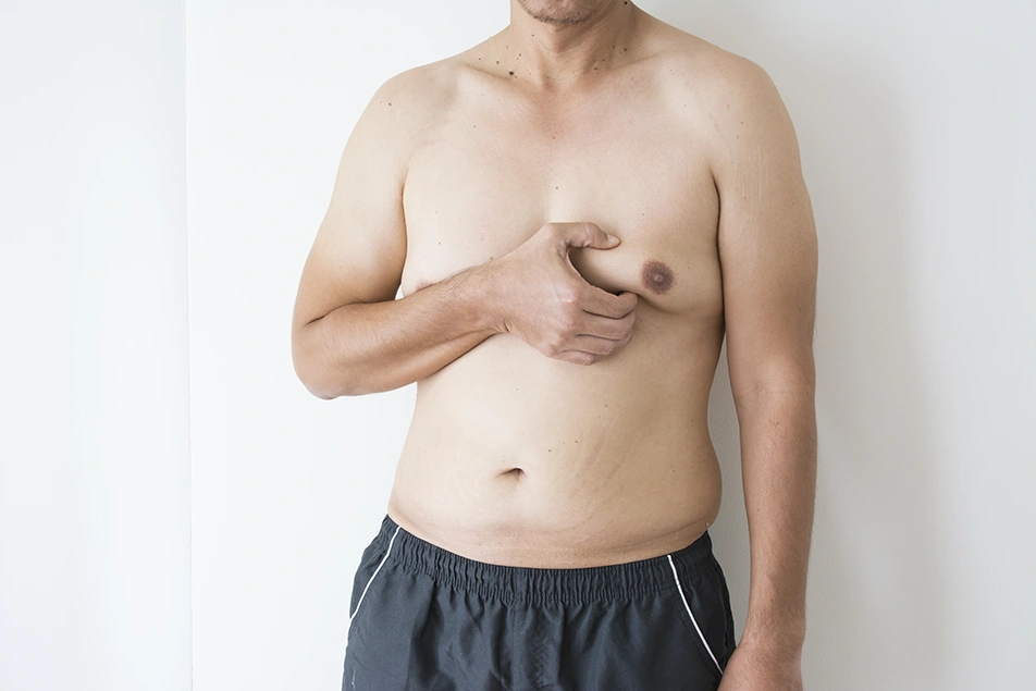 Man examining his chest showing signs of gynecomastia before treatment