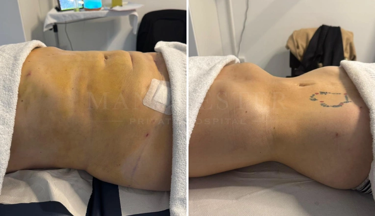 Results After 6 MLD Massages, Post op from Liposuction on Abdomen and Flanks