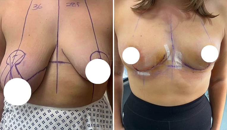 Breast Asymmetry before and after Results