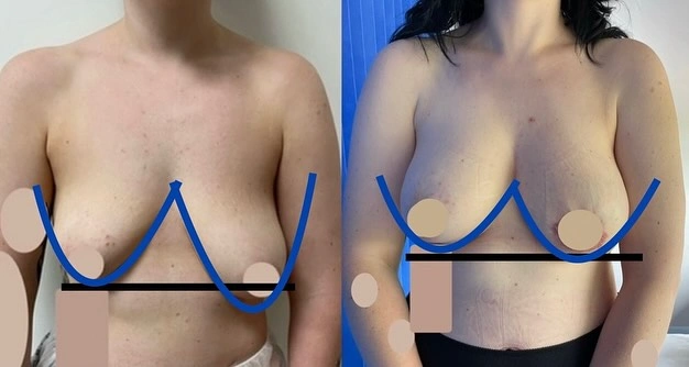Breast Asymmetry Surgery before and after Results