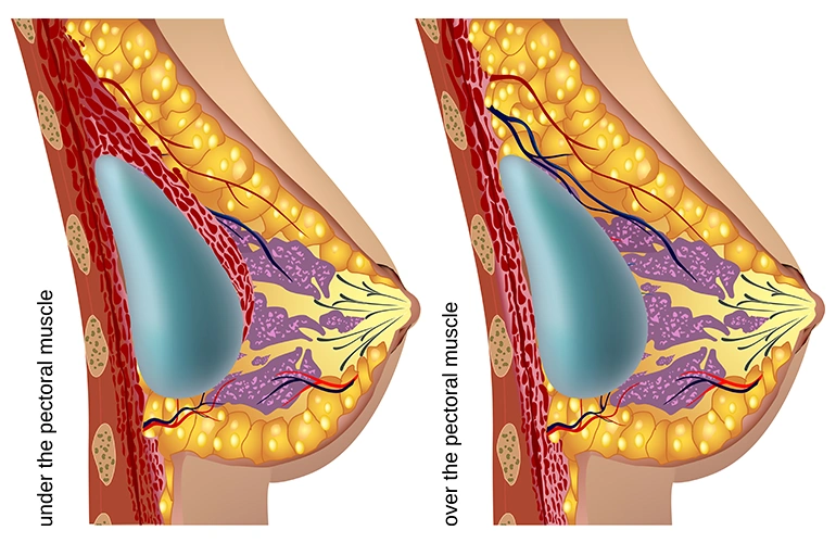 Medical diagram showing breast implant placement over the muscle (subglandular) and under the muscle (submuscular) for boob job