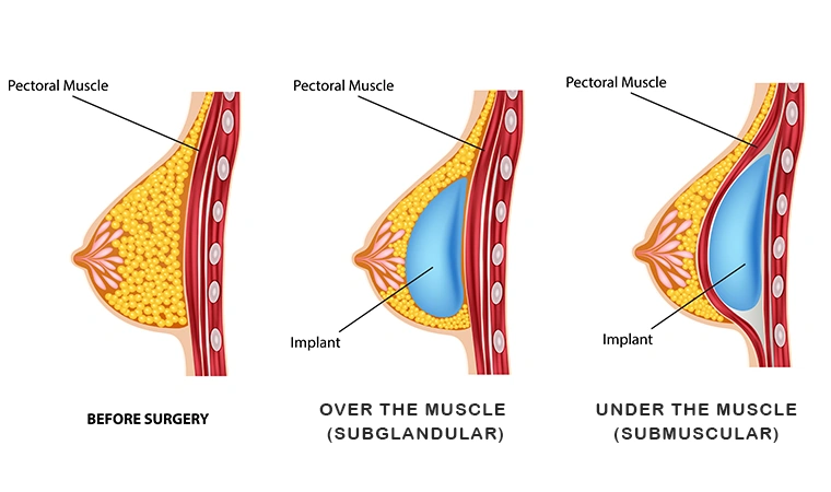 Medical diagram showing breast implant placement over the muscle (subglandular) and under the muscle (submuscular) for boob job under or over muscle comparison