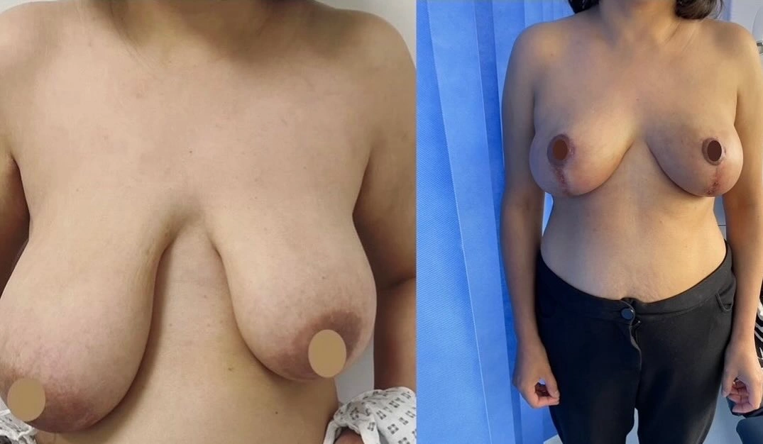 Breast Reduction Results and Symmetry