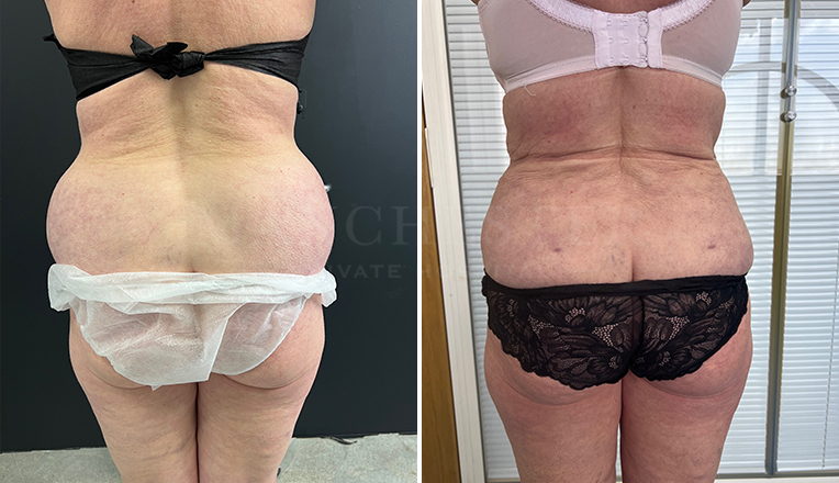 Flanks Vaser Liposuction Before and After