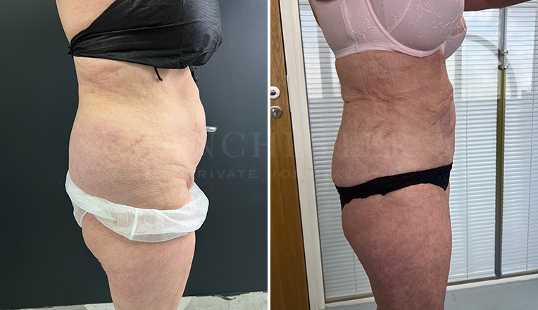 stomach vaser lipo before and after result