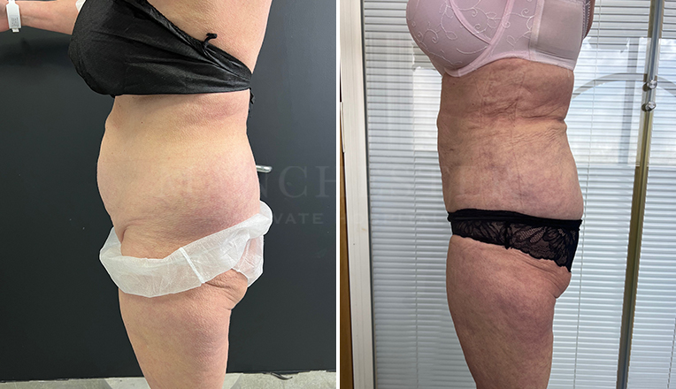 stomach vaser lipo before and after result