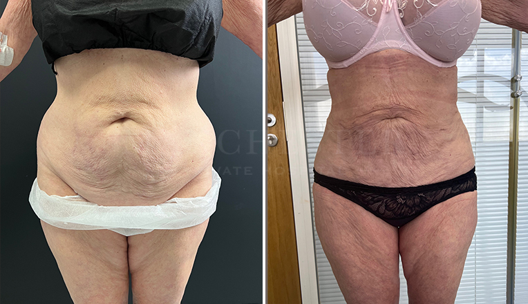 stomach vaser lipo before and after result