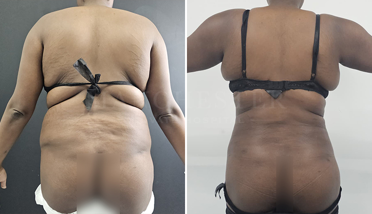 back vaser liposuction before and after result-21