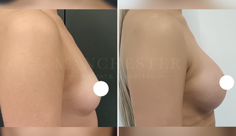 breast augmentation with smooth, round 300 cc high profile implants