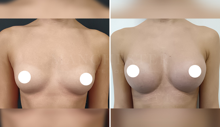 breast augmentation with smooth, round 300 cc high profile implants