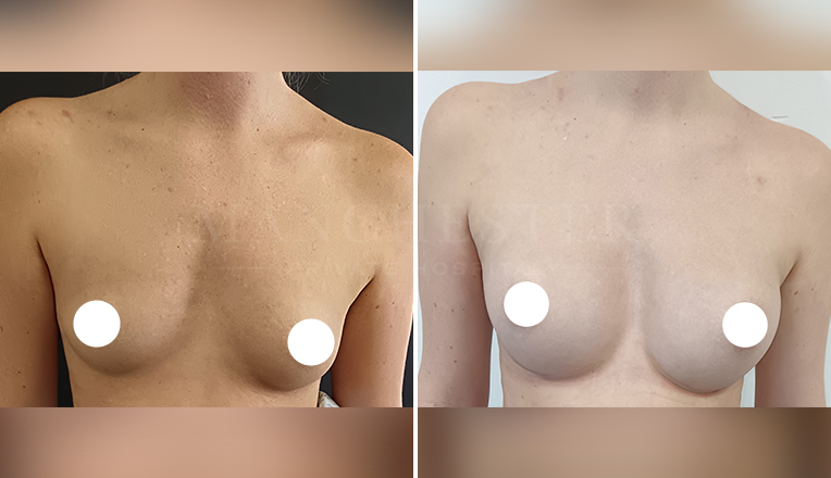 breast augmentation with smooth, round 350 cc high profile implants