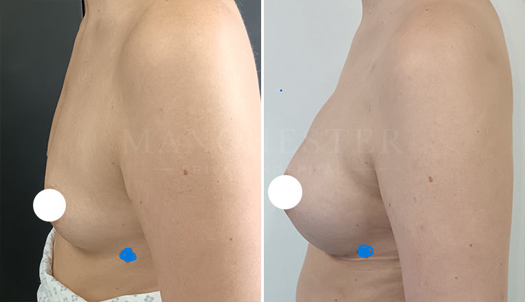 breast augmentation with smooth, round 350 cc high profile implants