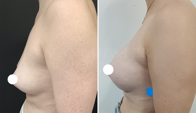 breast augmentation with smooth, round 350 cc high profile implants
