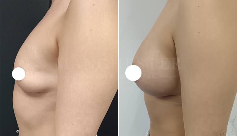 breast augmentation with smooth, round 375 cc high profile implants