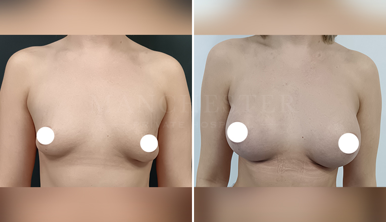 breast augmentation with smooth, round 375 cc high profile implants