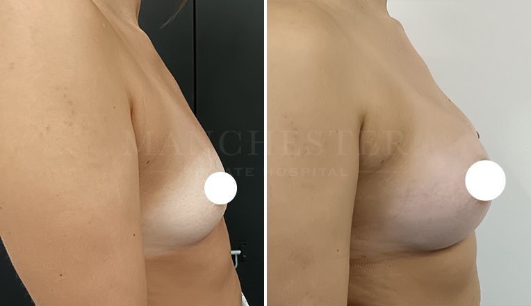 breast augmentation with smooth, round 400 cc high profile implants