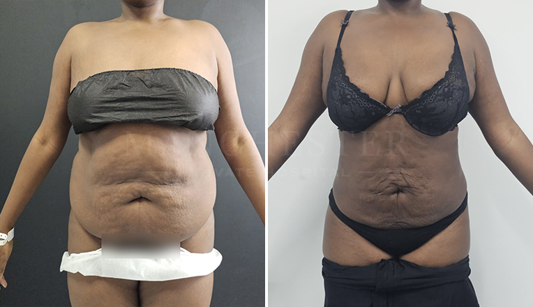 stomach vaser lipo before and after result-21
