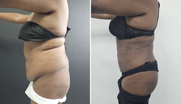 Vaser Liposuction on Abdomen & Flanks Result