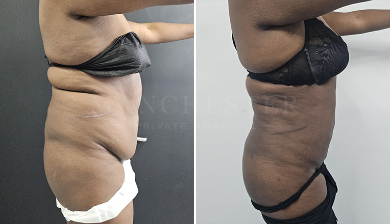 Vaser Liposuction on Abdomen & Flanks Result