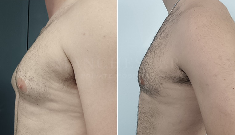 vaser liposuction and gland excision for Gynecomastia