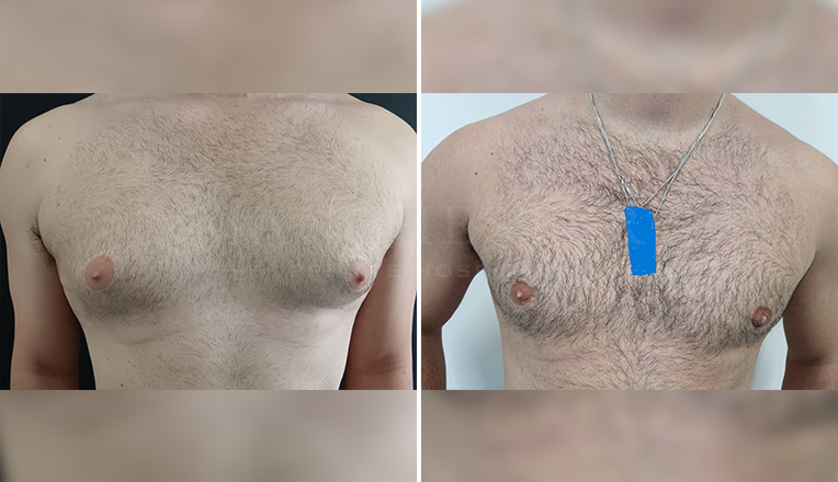 vaser liposuction and gland excision for Gynecomastia