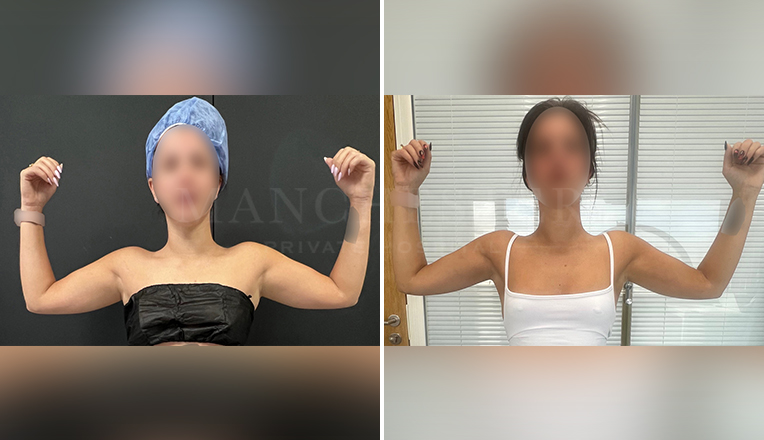 vaser-liposuction-to-upper-arms-and-upper-outer-back
