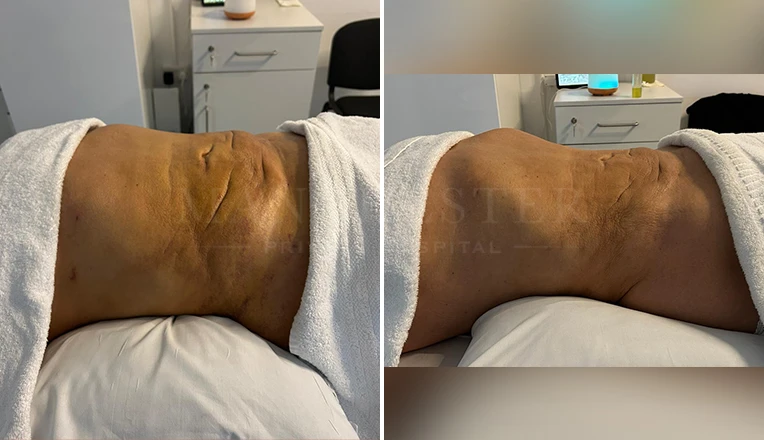 Results After 4 MLD Massages, Post op from Liposuction on Abdomen