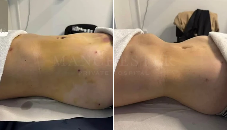 6 sessions of MLD after vaser liposuction on the abdomen and flanks